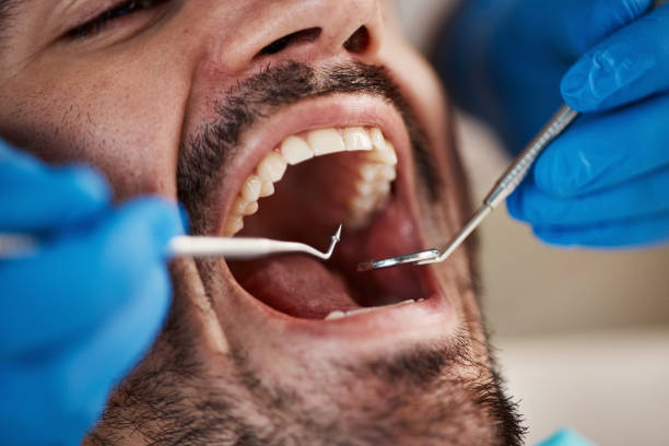 Best Knocked-Out Tooth (Avulsed Tooth) Treatment in La Selva Beach, CA
